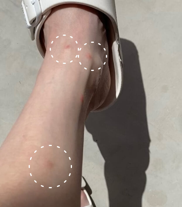 Image of a person's leg with three bug bites